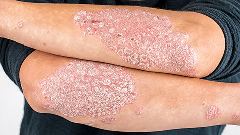 Psoriasis*